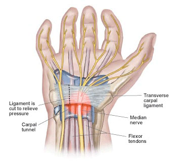 Carpal Tunnel Pain Treatment NJ & NYC